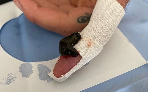 Sensation de morsure de sangsue